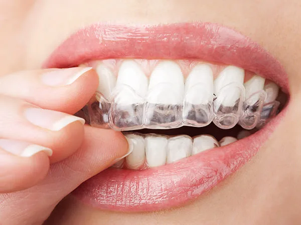 Aligneur transparent SmileFit présenté sur un modèle dentaire