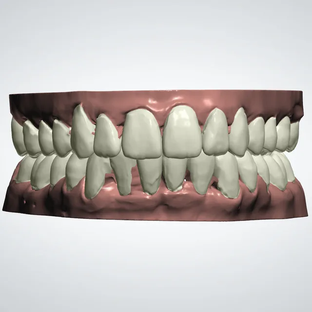Visualisation numérique d’une planification orthodontique SmileFit